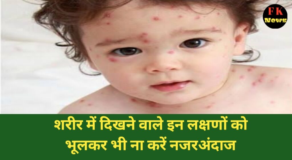 चेचक कैसे होता है
